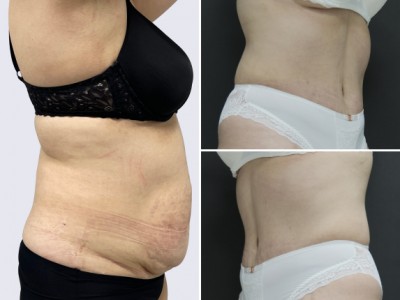 Видеокейс - Абдоминопластика с липосакцией живота и бедер. Пластический хирург Петрухина Н. В.