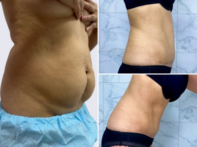 Видеокейс - Абдоминопластика с липосакцией живота